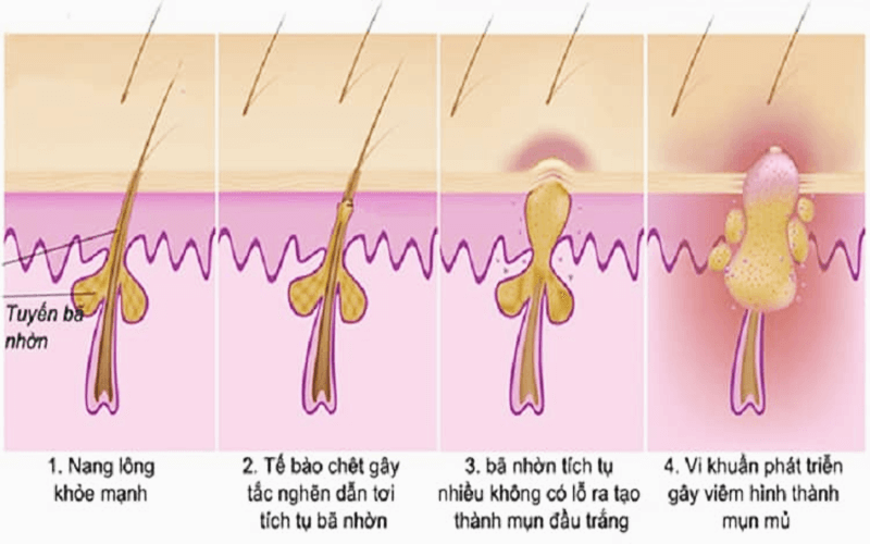 Mụn hình thành là do đâu?