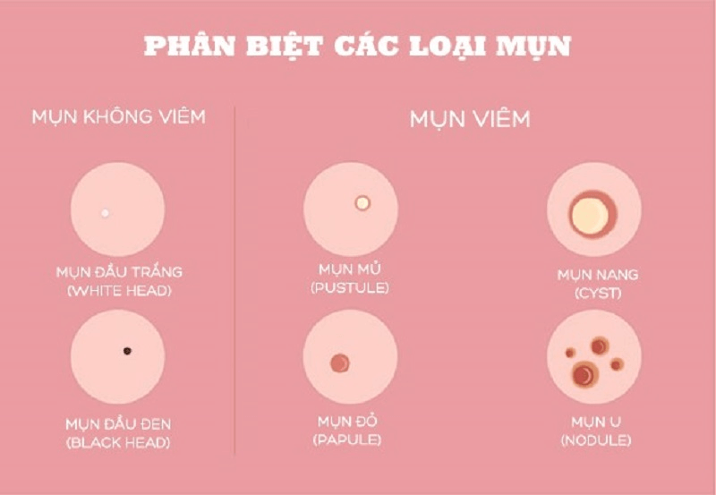 Nhận biết các loại mụn