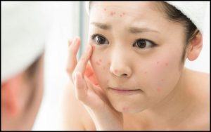 Cách trị mụn tại nhà