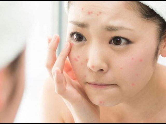 Cách trị mụn tại nhà