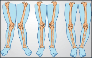 Cách làm chân thẳng