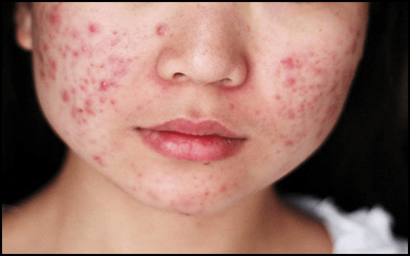 Mụn trứng cá được hiểu là tình trạng viêm da mãn tính.