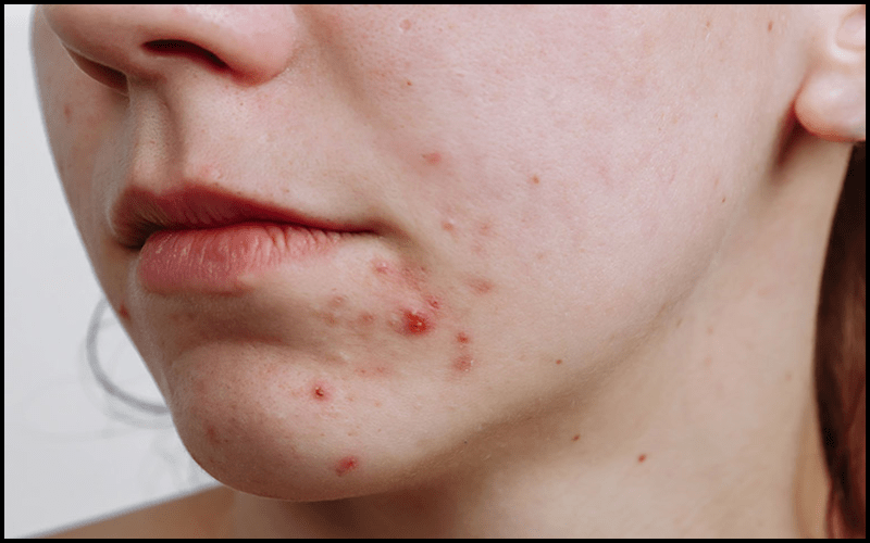 Phân biệt các loại mụn trứng cá 