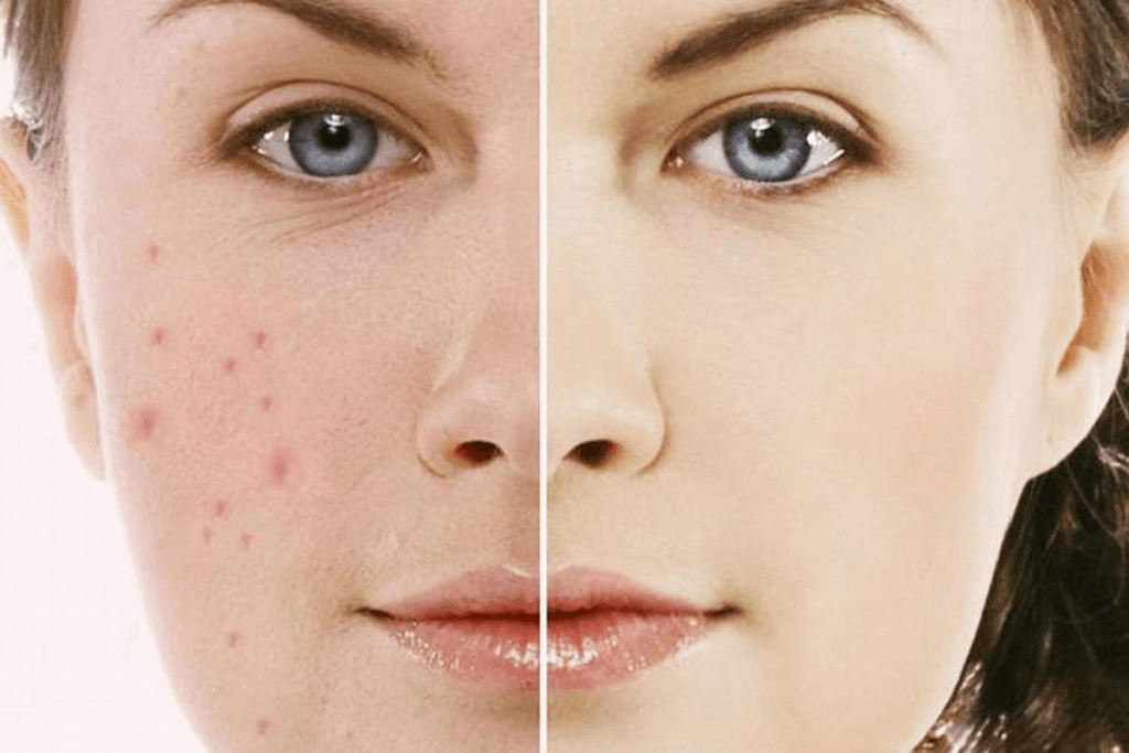 Cách trị mụn trứng cá