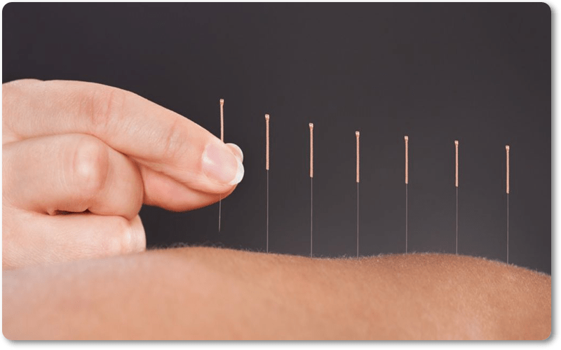 Phương pháp châm cứu, bấm huyệt