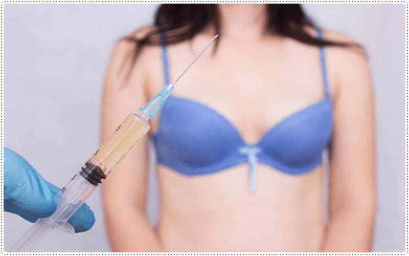 Nâng ngực bằng mỡ tự thân là gì?