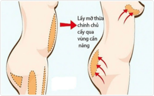 Nâng ngực bằng mỡ tự thân