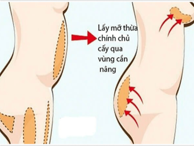 Nâng ngực bằng mỡ tự thân