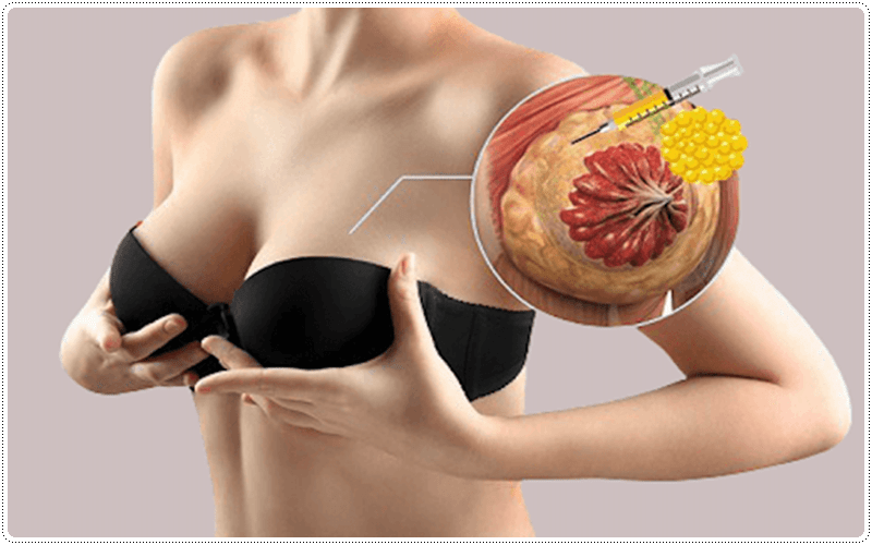 Vì là giải pháp thẩm mỹ không phẫu thuật nên cấy mỡ ngực tự thân được đánh giá là an toàn hơn so với nâng ngực nội soi.