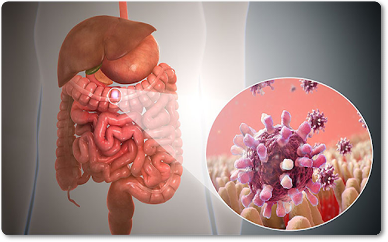Viêm dạ dày ruột là tình trạng đường tiêu hóa bị kích thích do vi rút, vi khuẩn và ký sinh trùng gây ra.