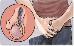 Giãn tĩnh mạch thừng tinh