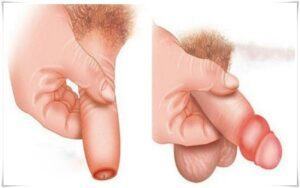 Nghẹt bao quy đầu là gì?