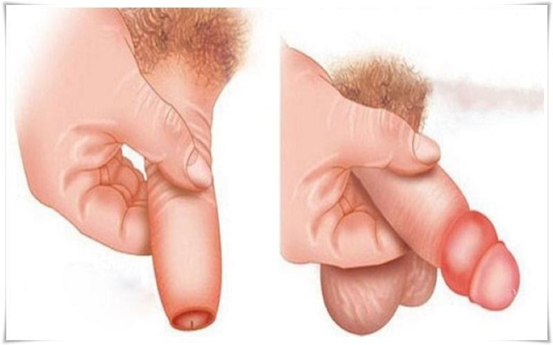 Nghẹt bao quy đầu là gì?