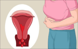 Triệu chứng đau bụng kinh là do đâu?