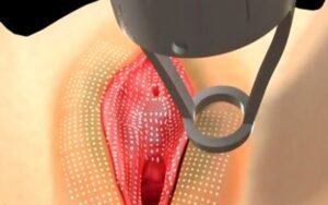 Có nên làm hồng vùng kín bằng laser không?